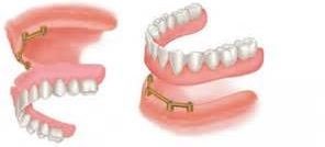 implant denture